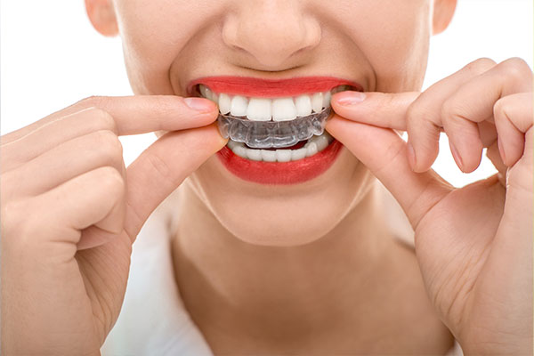 Invisible Braces Margate FL